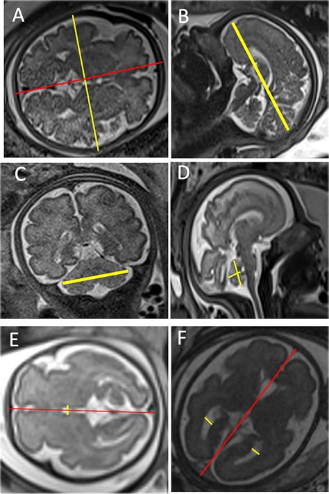 Brain Cortical Assessment By MRI In Fetuses With Left Congenital