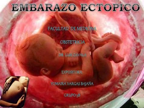 Embarazo Ectopico