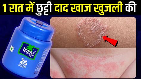 दद खज खजल क 15 मनट म छटट कर दग Fungal Infection Treatment