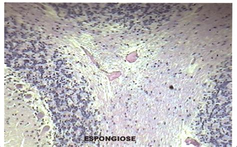 Histopathology Of The Calf Shown In Figure Showing The Vacuolation