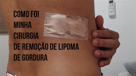 Cirurgia de remoção de lipoma das costas e como ficou a cicatriz após a