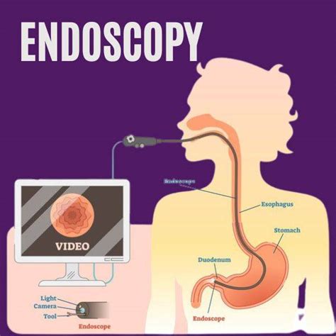 Esophagus cancer-symptoms, causes, diagnosis