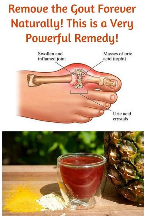 Remove the Gout Forever Naturally! This is a Very Powerful Remedy! # ...