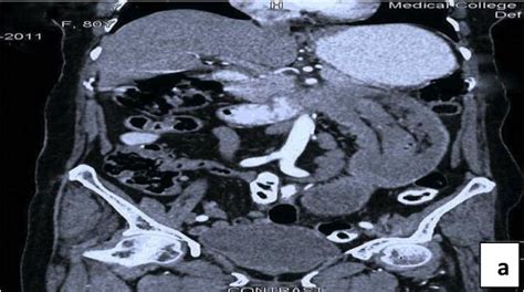 Figure 1 From A Rare Case Of Gastrointestinal Stromal Tumors Presenting