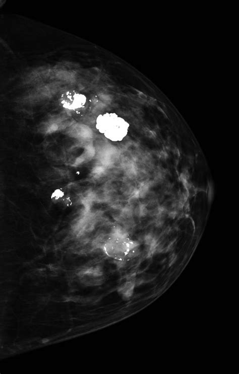 Fibroadenoma Other Imaging Findings Wikidoc