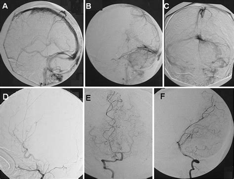 Patient 2 A And B Venous Phase Of Lateral And C AP DSA Showing The