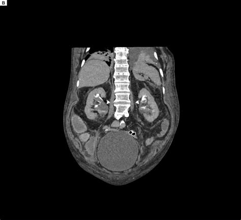 B Multiplanar Reconstruction Of The Abdominal Computed Tomography Ct