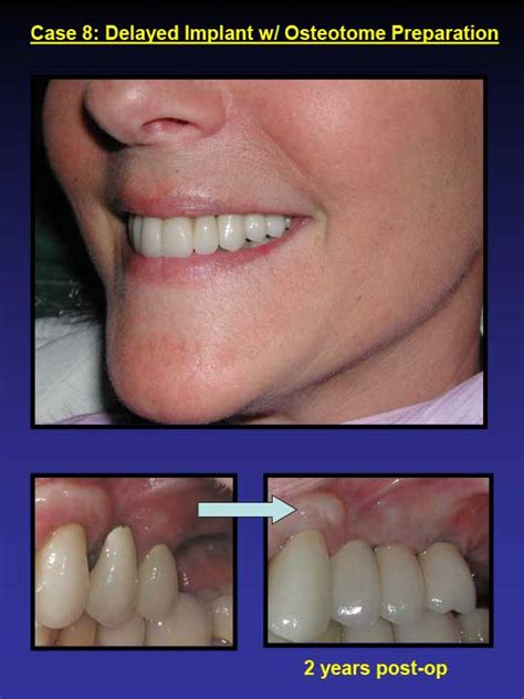 Affordable Dental Implants Dental Care Of Greensboro NC