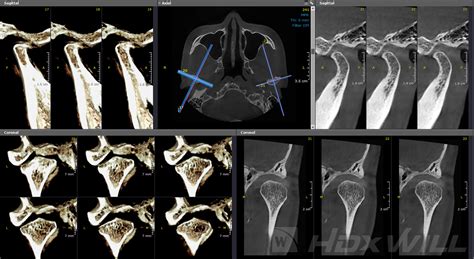 Dentri Sistema Dental CBCT TAC 3D Recursos Médicos