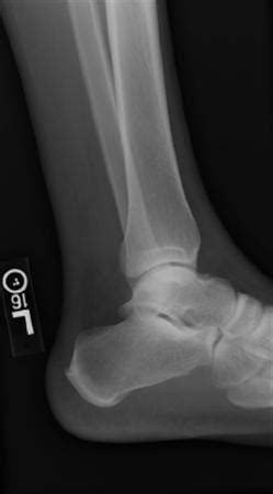 Achilles Tendon Rupture - Foot & Ankle - Orthobullets / Achilles Tendon ...