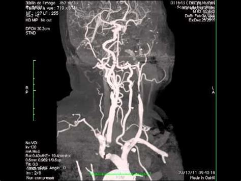 Amaurosis Fugax