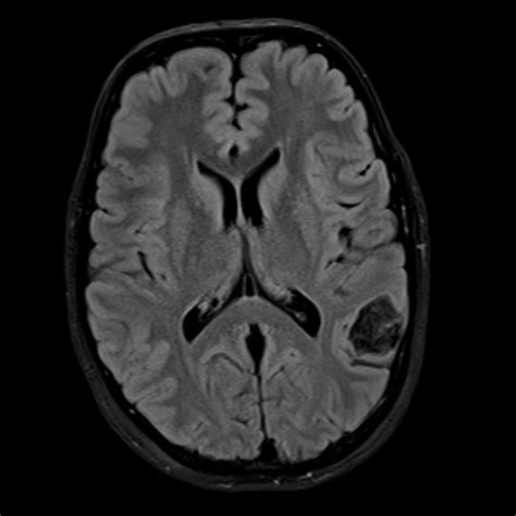 Intracranial Epidermoid Cyst Pacs