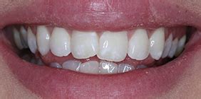 Invisalign Clear Aligners In Liverpool See Us At Dr Rez Dental For