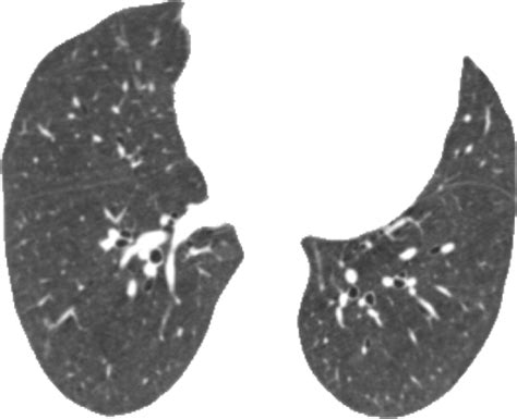 Deep Learning Enables Automatic Classification Of Emphysema Pattern At