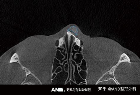 Medfore损坏的鼻中隔重建整形鼻部修复手术（鼻梁鼻尖人中功能鼻）前后事例 知乎