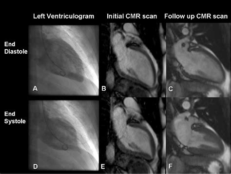 Figure 1 From Acute Myocarditis Mimicking Reverse Takotsubo