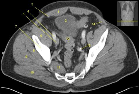 Pelvis CT II Diagram Quizlet