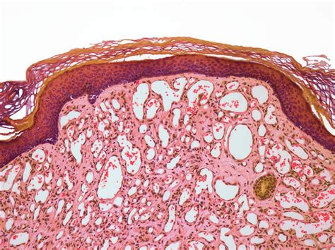 Capillary Hemangioma Photograph By Steve Gschmeissner Science Photo