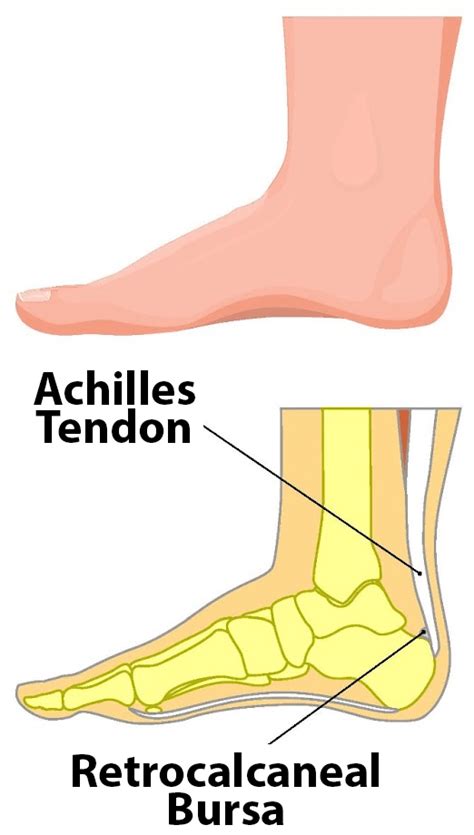 Battling Haglund S Deformity A Journey Toward Relief Foot Ankle