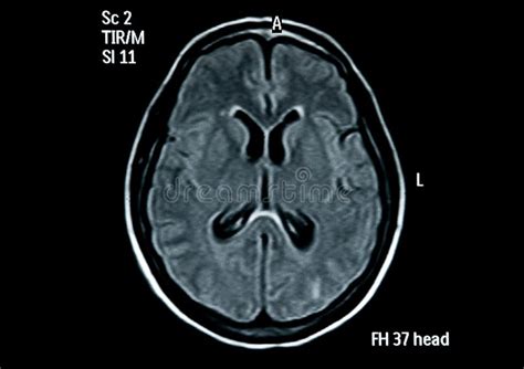 脑子图象mri 库存照片 图片 包括有 医院 医疗 设计 页面 金属 反映 头脑的 健康 照亮 6966054