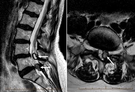 Synovial cyst on spine - shoppingbopqe