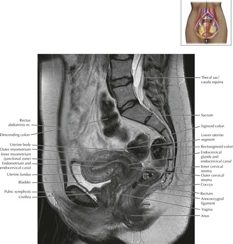 Mri Anatomy Female Pelvis At Martin Huey Blog