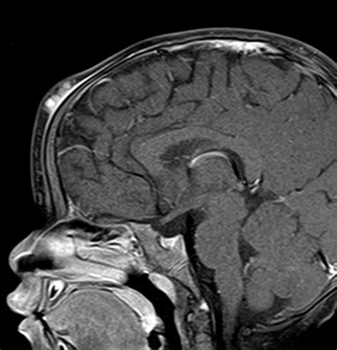 Infantile Hemangioma Of The Scalp Image