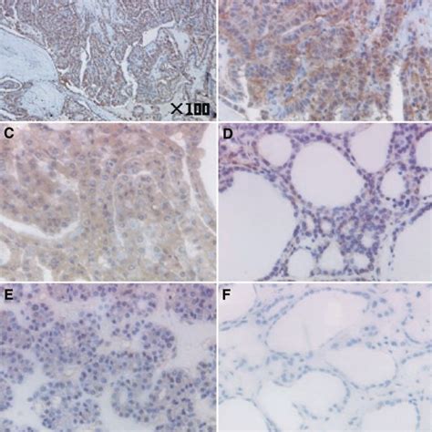 Overexpression Of Basic Fibroblast Growth Factor Bfgf In Papillary