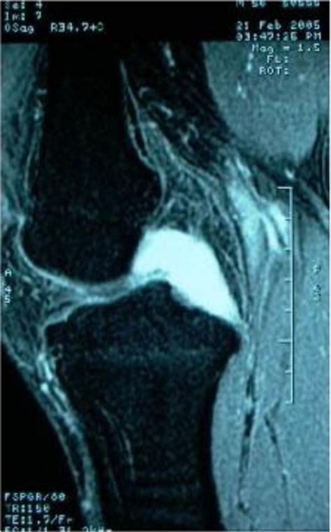 Sagittal Fat Suppressed T Weighted Mr Image Showed Hyper Intensity