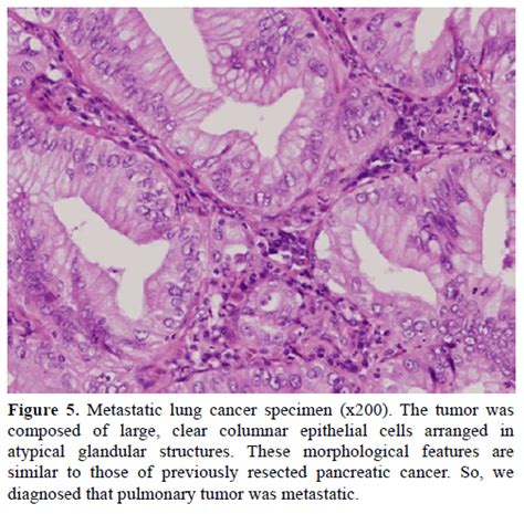 Metastatic Pulmonary Adenocarcinoma 13 Years After Curative Resec