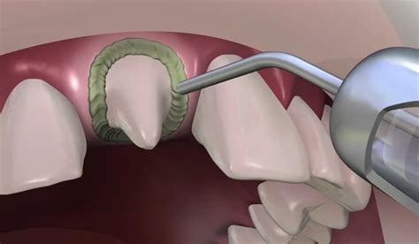 Prevest Hemostal Gel Alpha Dentkart