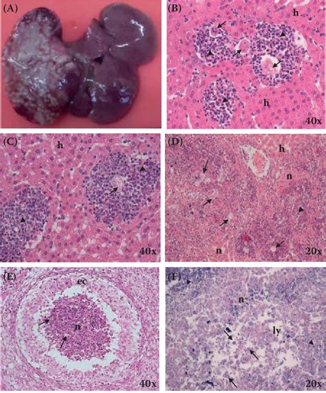 Liver Abscess Amebiasis Due To Entamoeba Histolytica