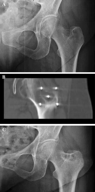 A Year Old Patient Left Femoral Neck Painful Bone Metastases