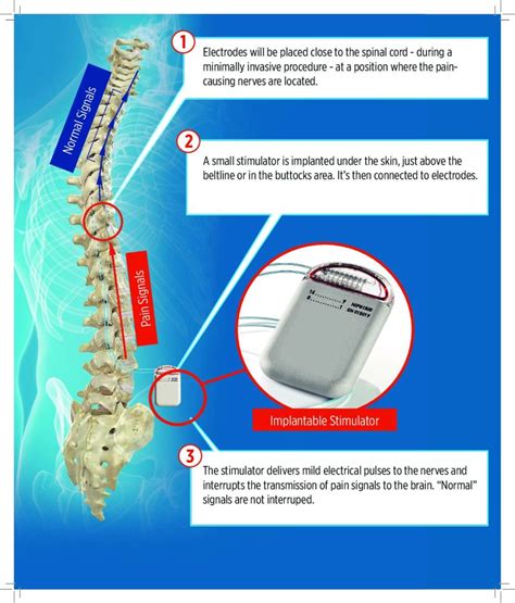 Spinal Cord Stimulation – Dr Thomas E Smith