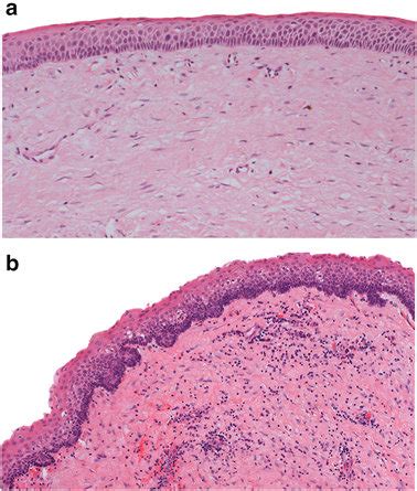 The First Photomicrograph A Shows A Typical Odontogenic Keratocyst