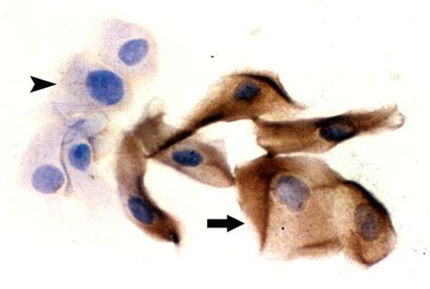 Detection Of Hsv 1 Antigen An Impression Cytology Smear Obtained From Download Scientific