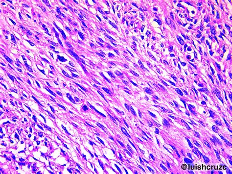 Patología CC Sarcoma sinovial bifásico Biphasic synovial sarcoma