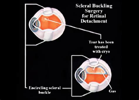 Scleral Buckle And Retina Repair Retinal Consultants Medical Group