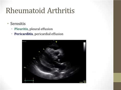 Rheumatoid Arthritis My Wiki