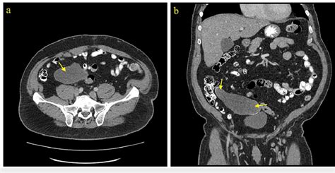 Ct Abdomen And Pelvis With Contrast Case 3 A Axial View Showing A Download Scientific