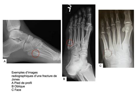 Fracture De Jones Ou Fracture De La Base Du Me M Tatarsien Sos Pied