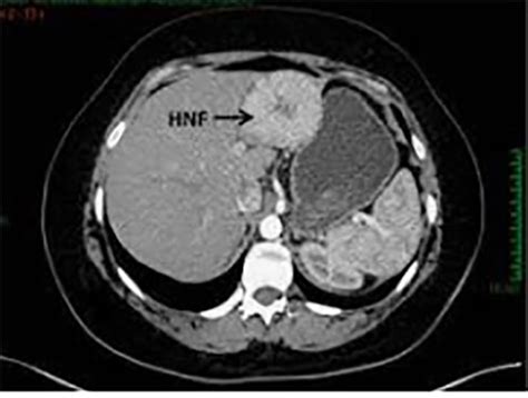 Hiperplasia Nodular Focal Imsn Instituto Medicina Sa De E Nutri O