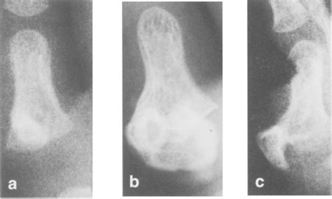 Figure From Bizarre Parosteal Osteochondromatous Proliferation In A