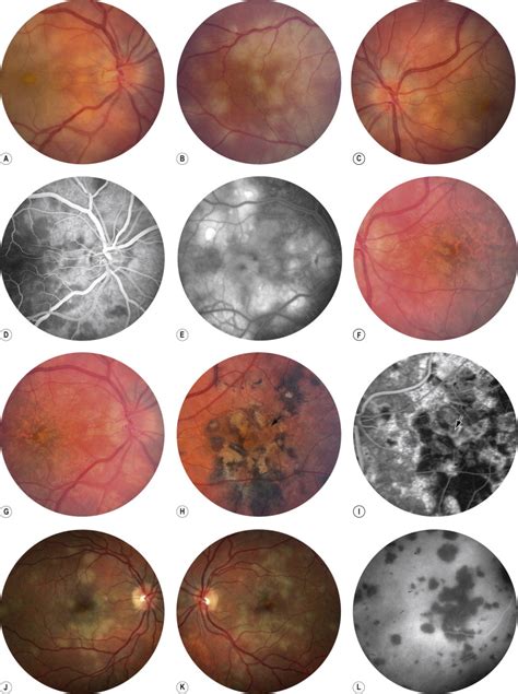 Inflammatory Diseases of the Retina | Ento Key