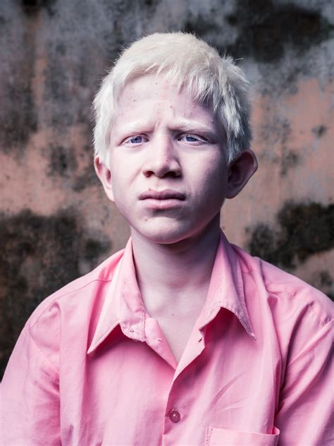 Indian Boys With Albinism — Brent Stirton