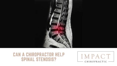 Can A Chiropractor Help Spinal Stenosis