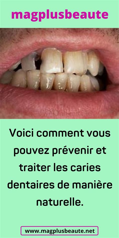 Voici comment vous pouvez prévenir et traiter les caries dentaires de