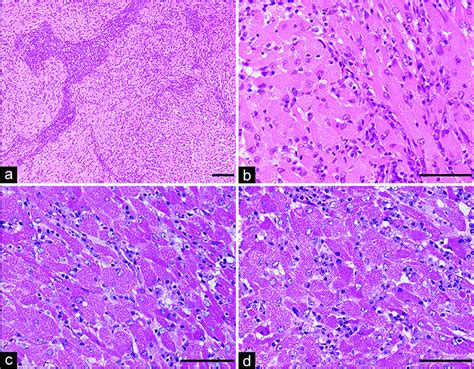 Granular Cell Tumor Electron Microscopy