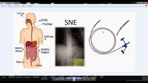 SNE SNG Gastrostomia e Jejunostomia Básico YouTube