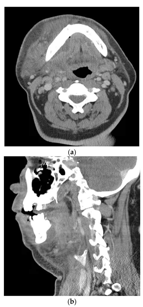 Complications Of Severe Odontogenic Infections A Review